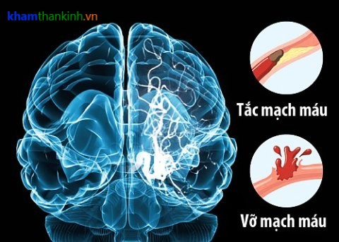 Kỹ thuật can thiệp nội mạch trong nhồi máu não cấp tính.